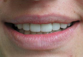 The image shows a close-up of a person s smiling face with teeth, capturing the upper lip area and part of the chin.